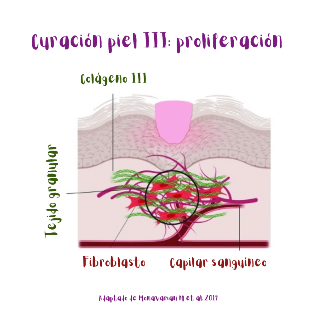 Etapa IIIde la curación de heridas cutáneas: proliferación (ilustración). Se forma el tejido granular en la sitio de la lesión,y los nuevos fibroblastos sintetizan colágeno de tipo III.