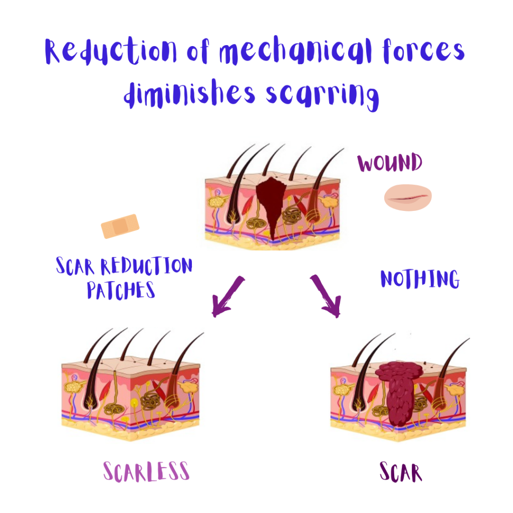 The reduction of mechanical forces at the wound site with scar reduction patches results in diminished scarring (illustration).