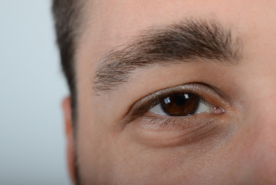 Photography of man with dark circles and puffiness around the eyes.